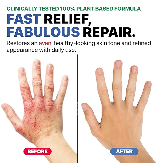 Eczema Cream for Adults & Kids – Hypoallergenic Barrier Repair Moisturizer, Clinically Proven (3 Studies), Fragrance-Free, Dermatologist Tested, Face & Body Hydration, NEA Accepted, USA Made