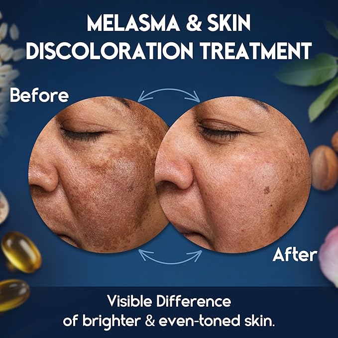 Melasma Treatment for Face - Melasma Cream & Age Spot Remover for Skin Discoloration, Post-Blemish Marks, Scars & Spots | Dark Spot Remover for Face & Body