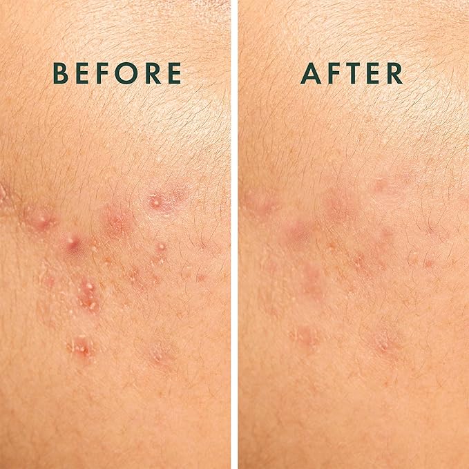 Rael Pimple Patches, Miracle Spot Control Cover - Hydrocolloid Acne Patch, Strips for Zits and Blemish, Korean Skin Care, Vegan, Cruelty Free (20 Count)