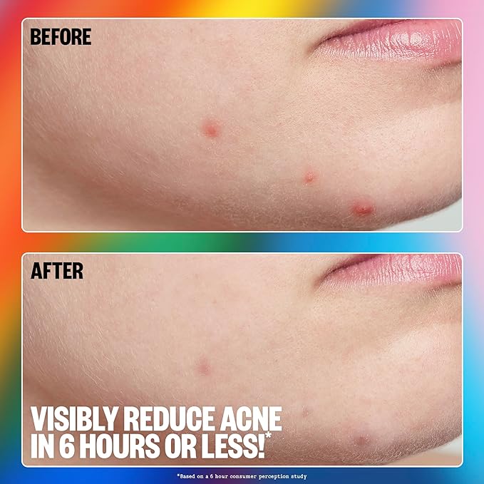 PEACE OUT Acne Healing Pride Dots Helps Clear Blemishes Overnight, Fast Acting Hydrocolloid Pimple Patches for Breakouts with Salicylic Acid, Retinol and Aloe Vera, Award Winning Skincare 16 Count