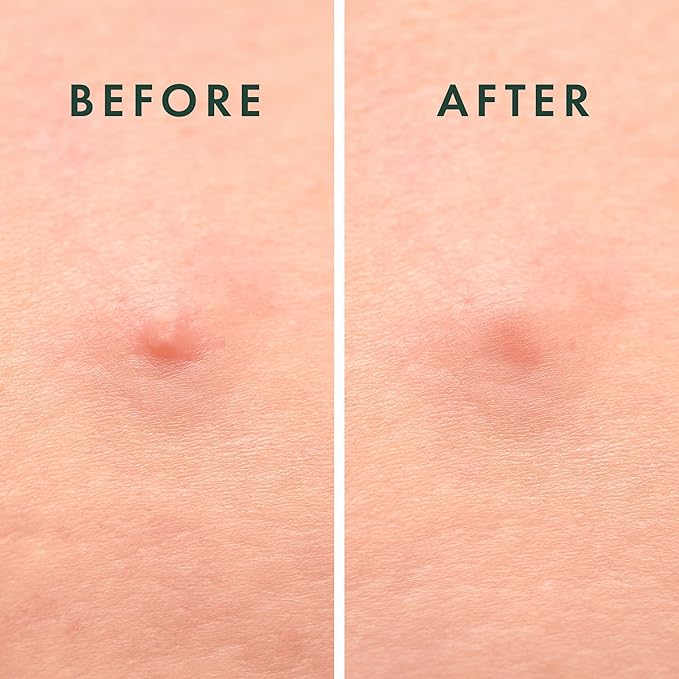 Rael Pimple Patches, Miracle Microcrystal Spot Cover - Hydrocolloid Acne Patch with Tea Tree Oil, Early Stage Zits and Blemish, Korean Skin Care, Vegan, Cruelty Free (9 Count)