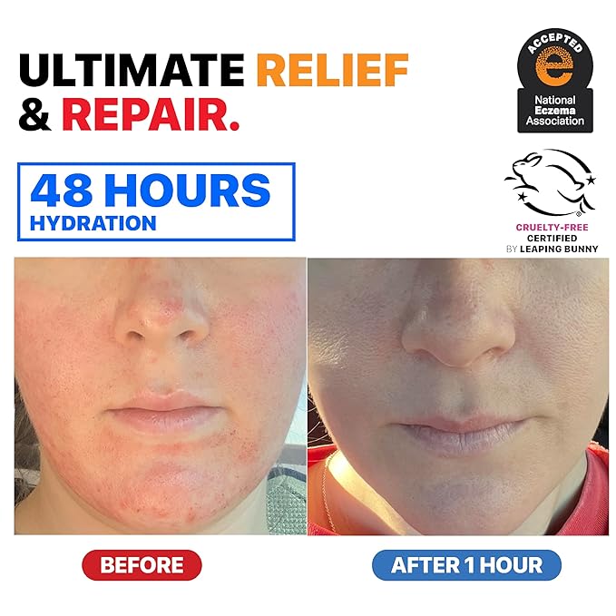 Eczema Cream for Adults & Kids – Hypoallergenic Barrier Repair Moisturizer, Clinically Proven (3 Studies), Fragrance-Free, Dermatologist Tested, Face & Body Hydration, NEA Accepted, USA Made